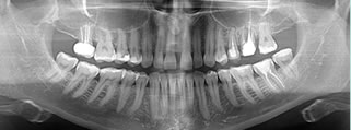 2D Dental Görüntüleme (Panoromik-Sefalometri)