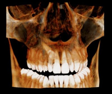 Dental tomografi (CBCT) ile elde edilmiş 3 boyutlu çene ve diş görüntüsü