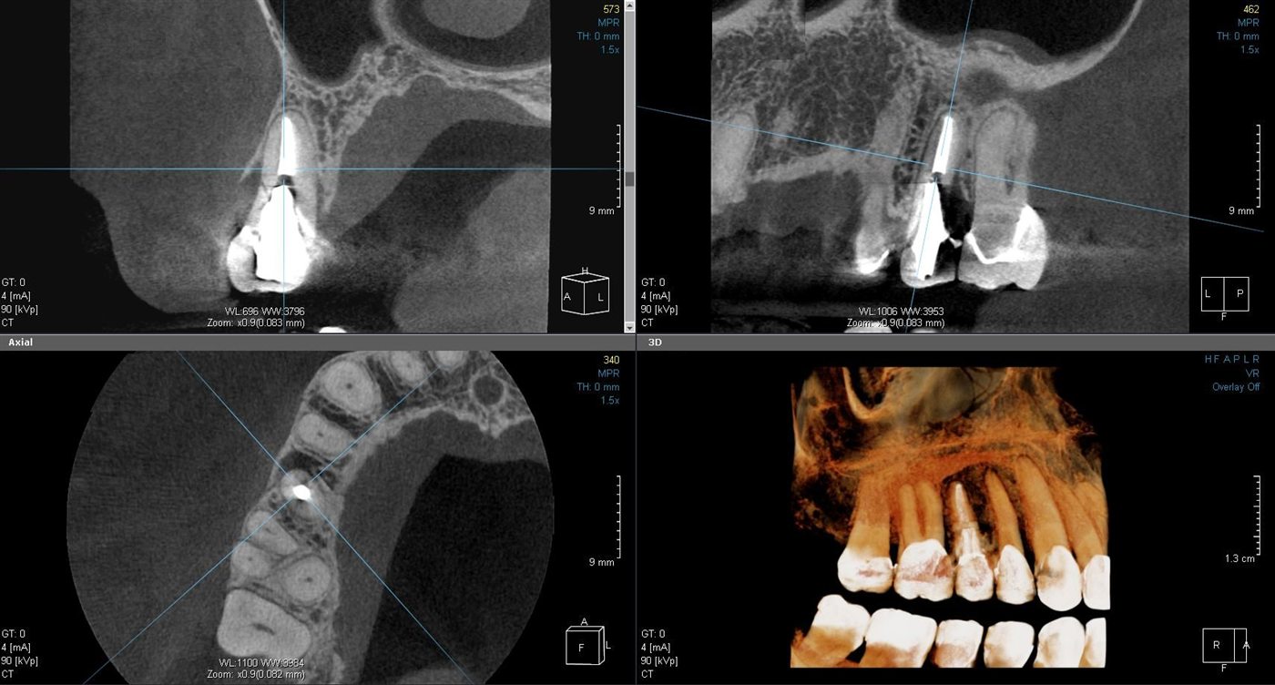 Dental tomografi (CBCT) örnek görüntüsü: üst çenede kanal tedavili dişin kesitleri ve 3 boyutlu görüntüsü