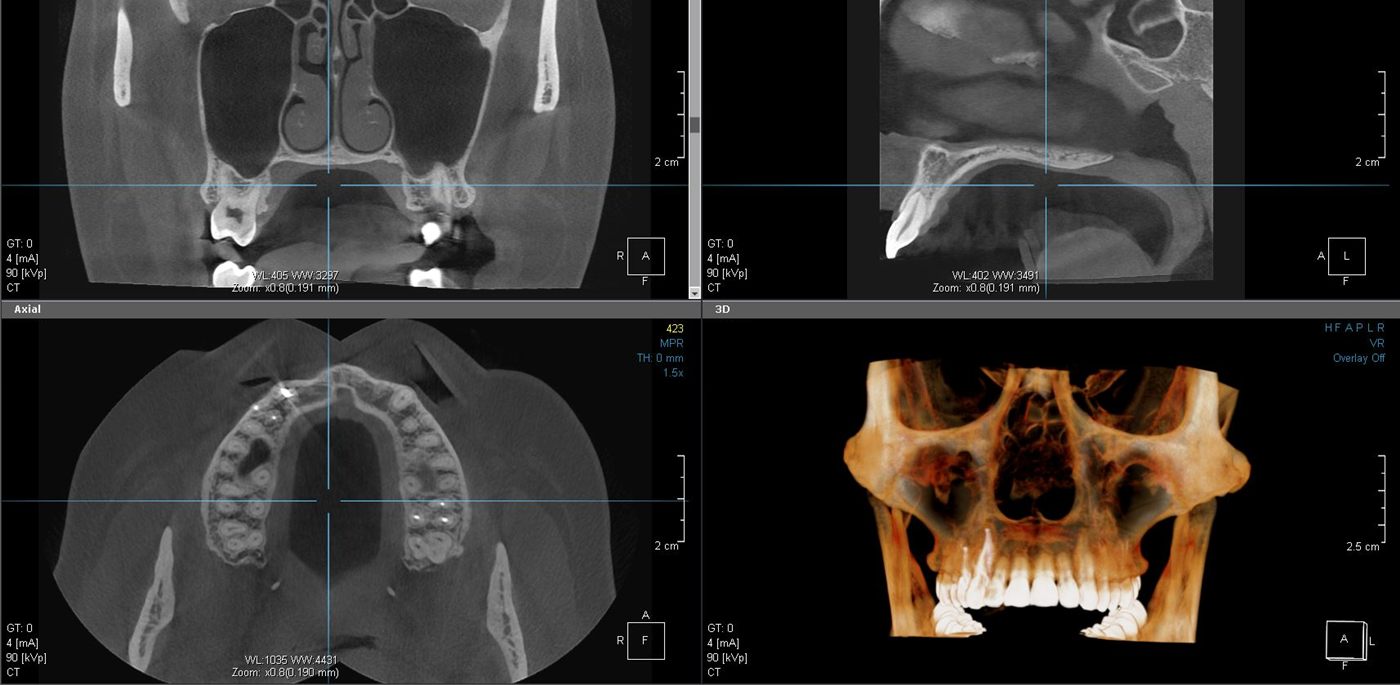Dental tomografi (CBCT) örnek görüntüsü: koronal, sagittal ve aksiyel kesitler ile 3 boyutlu görüntü